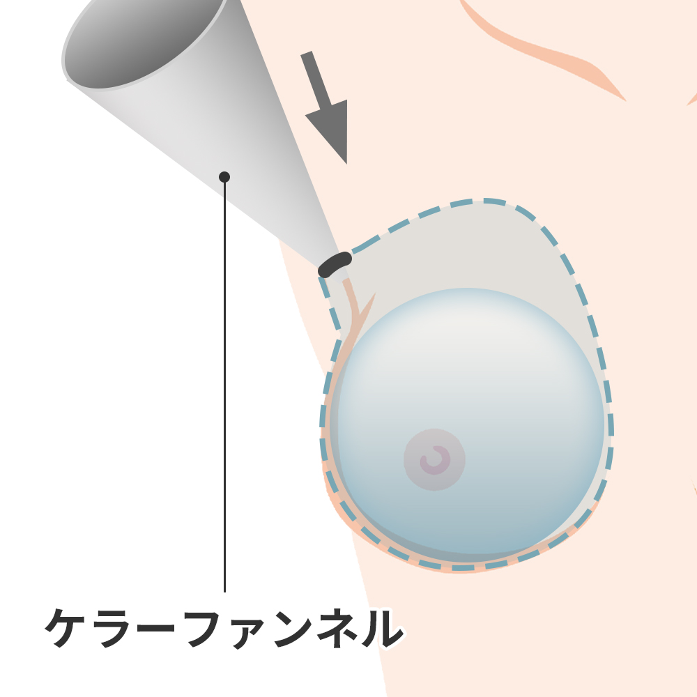 シリコン 豊胸 術後の サポーター バンド