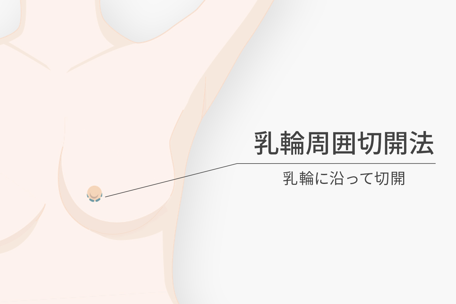乳輪周囲切開法