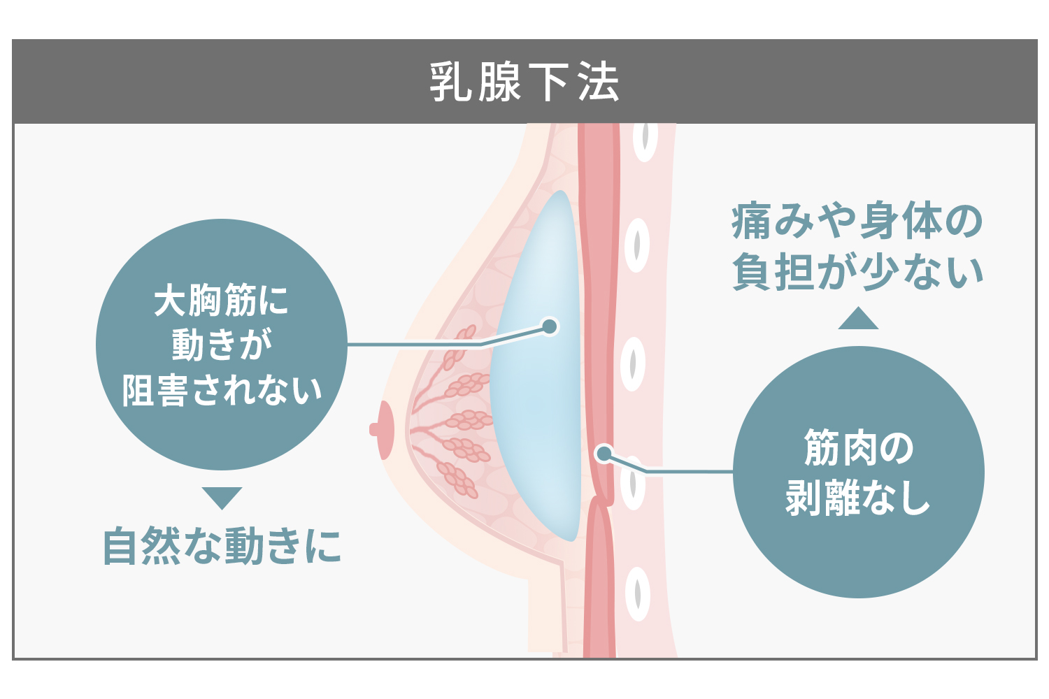 乳腺下法