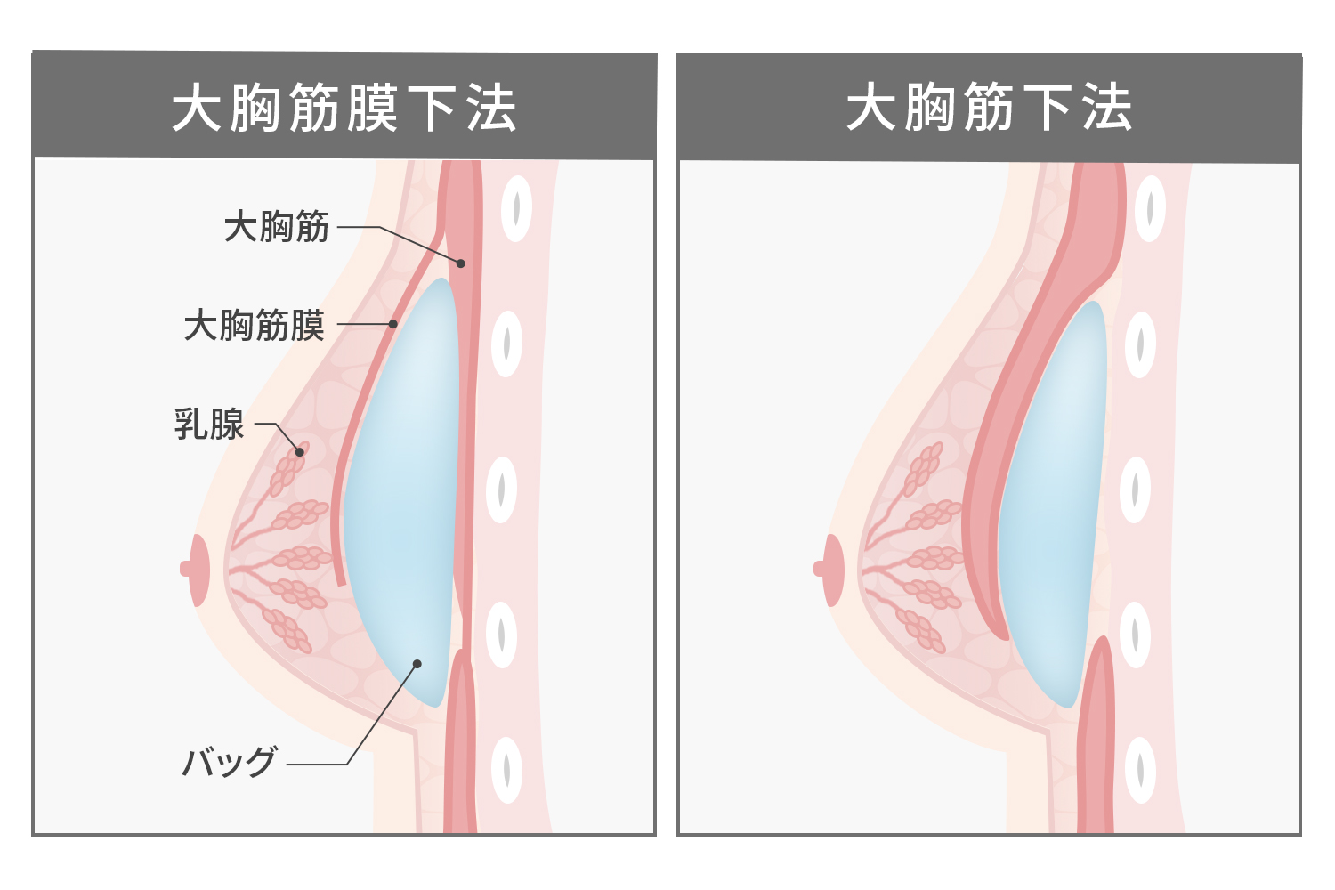 大胸筋膜下法 ・大胸筋下法