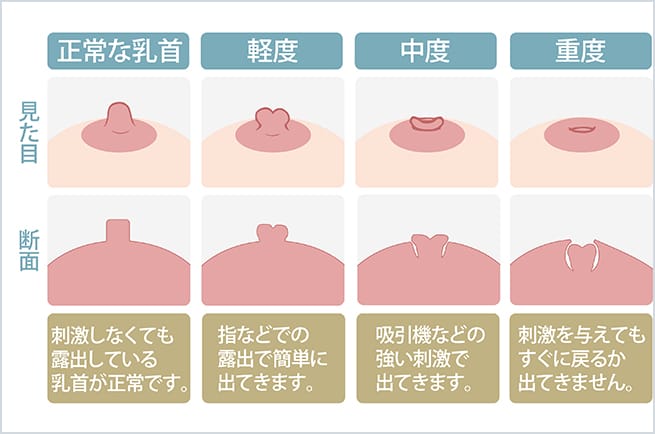 陥没乳頭 陥没乳頭（陥没乳首）の手術｜日本医科大学武蔵小杉病院
