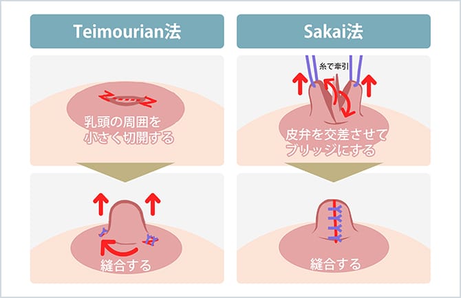 陥没乳頭の症状についてのイラスト
