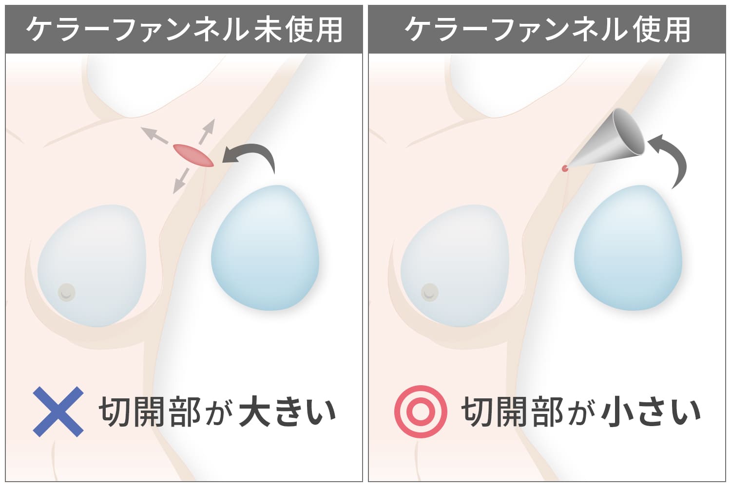 ケラーファンネルの特徴・メリット