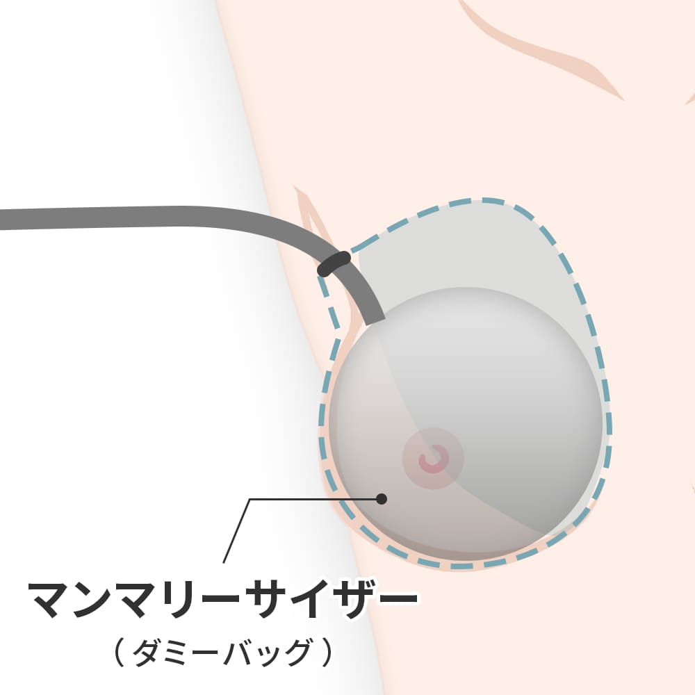 ダミーバッグを挿入する