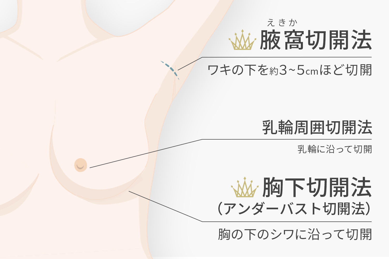切開位置