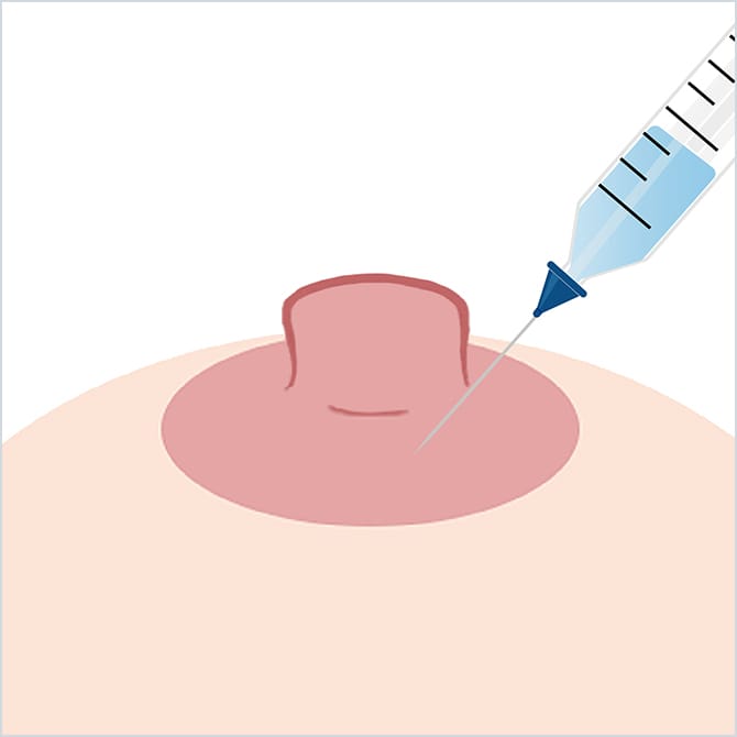 乳頭に局所麻酔するイラスト
