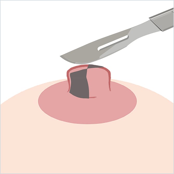 乳頭を切除するイラスト