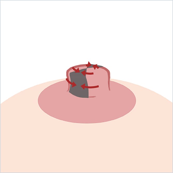 乳頭の切開・切除した部分を寄せ合わせるイラスト
