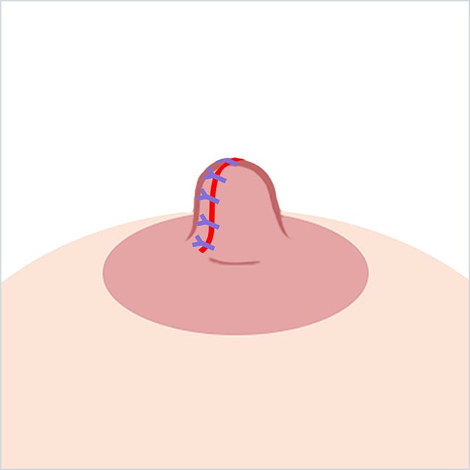 乳頭を縫合するイラスト