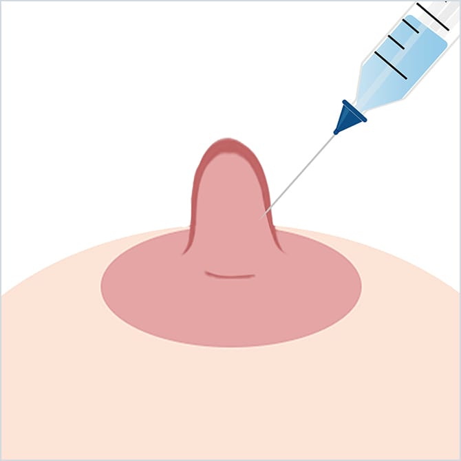 乳頭に局所麻酔するイラスト