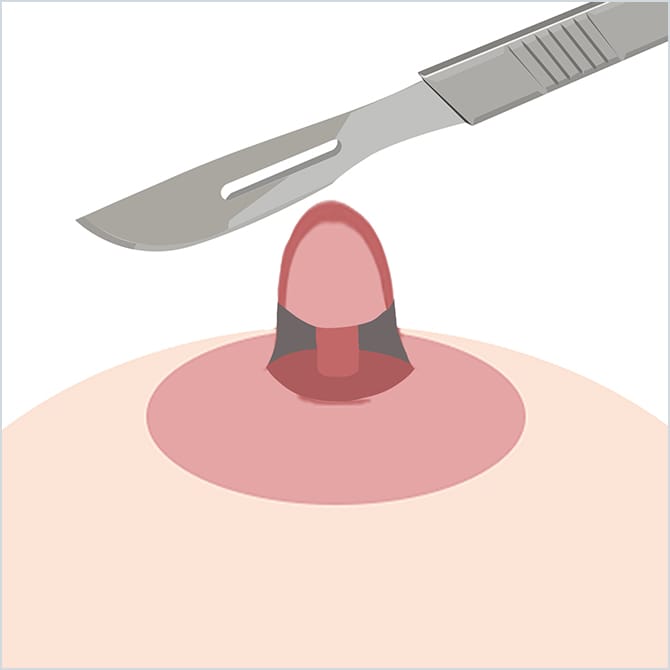 乳頭の周囲を切除するイラスト