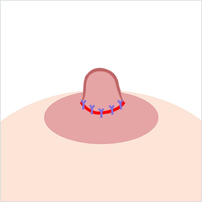 乳頭の周囲を縫合するイラスト