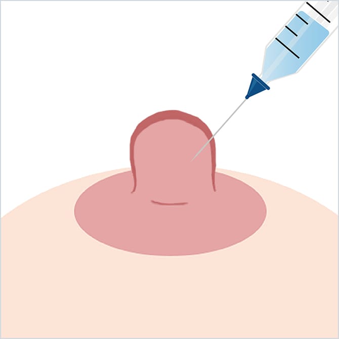 乳頭に局所麻酔するイラスト