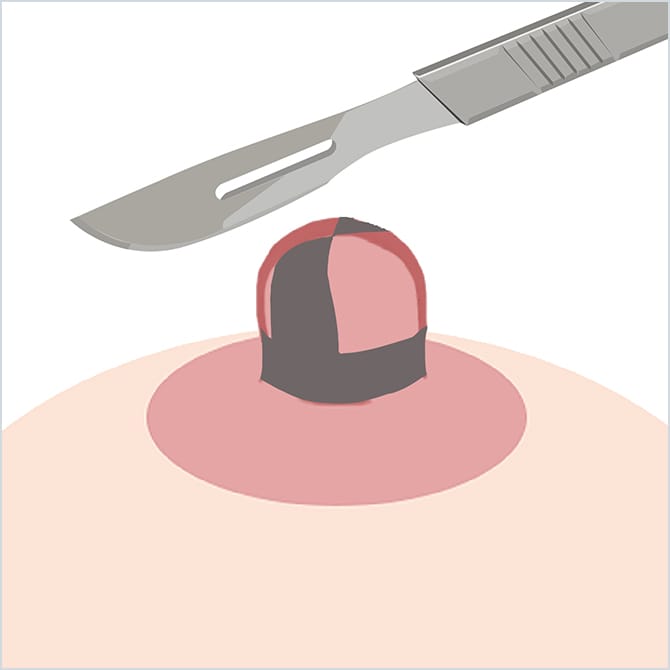 乳頭の周囲を切除するイラスト