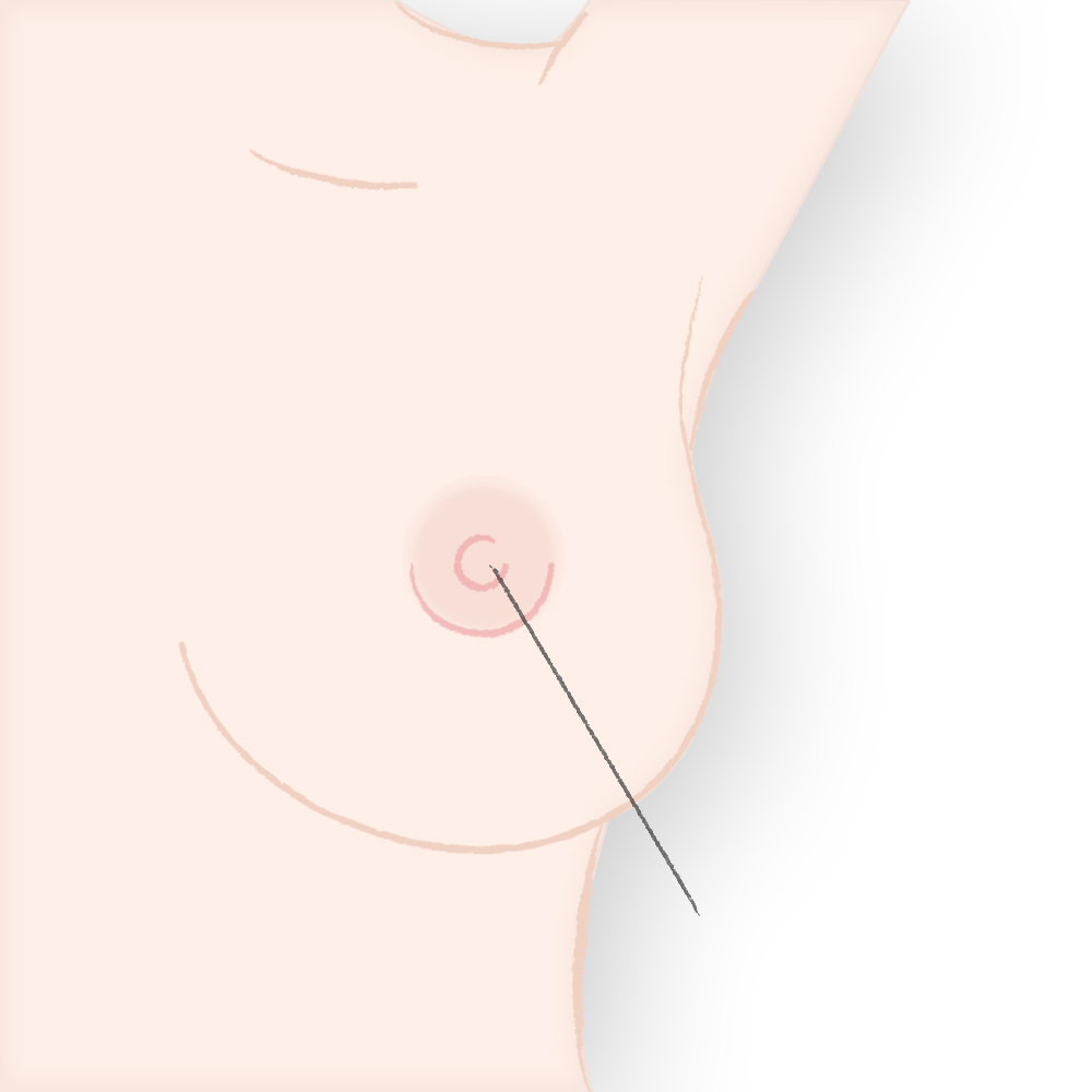 チュメセント液を浸潤させる