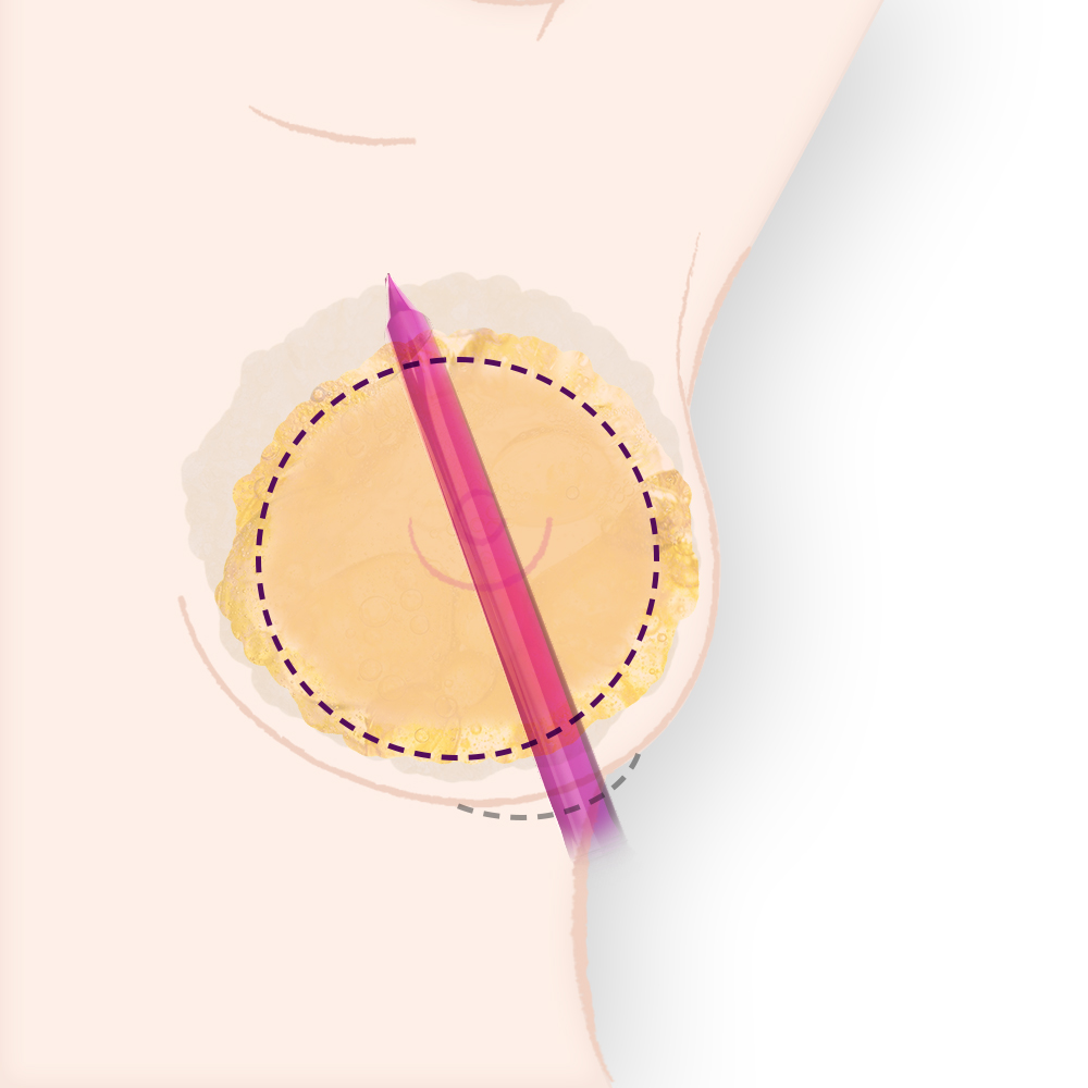トンネル（ポケット）を作成