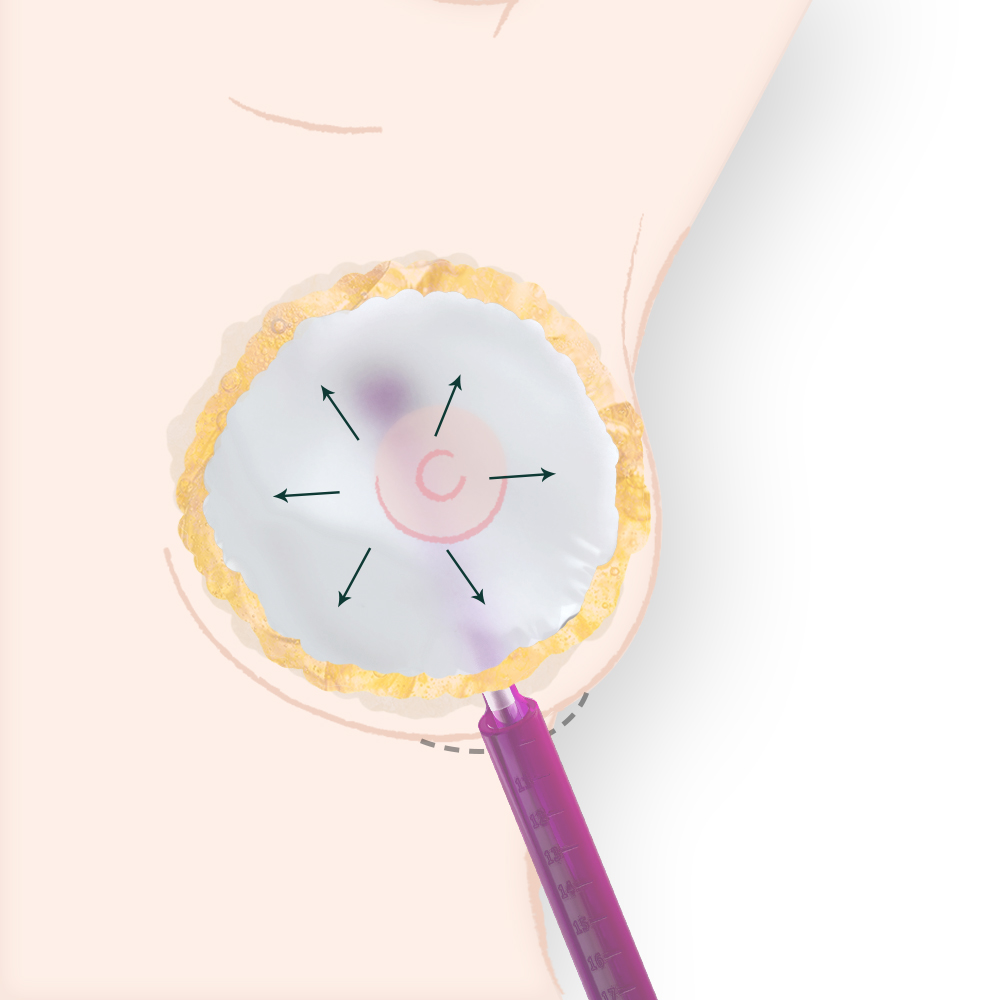 ポケットの形状と張力を調整