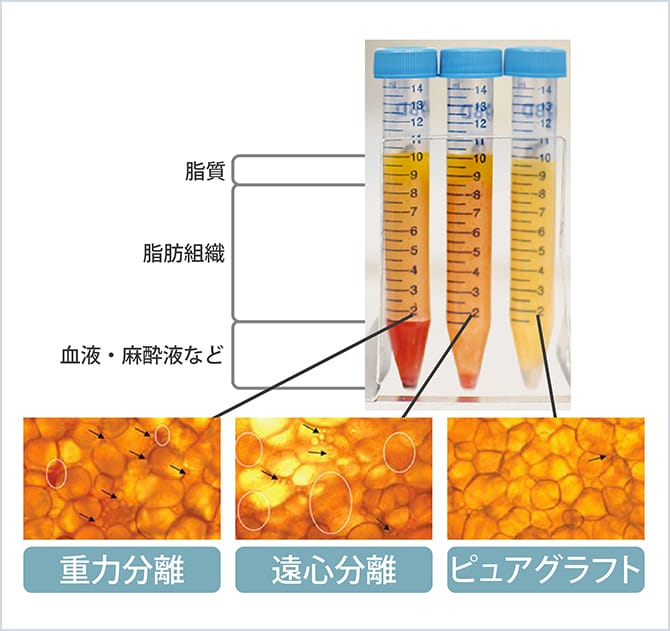 吸引した自分の脂肪から不純物を取り除く「ピュアグラフト