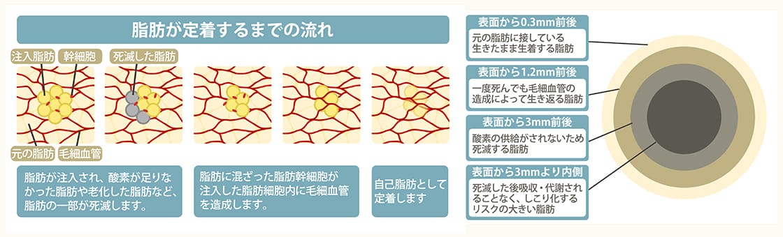 脂肪が定着するまでの流れ