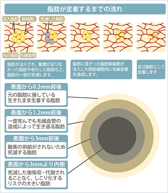脂肪が定着するまでの流れ