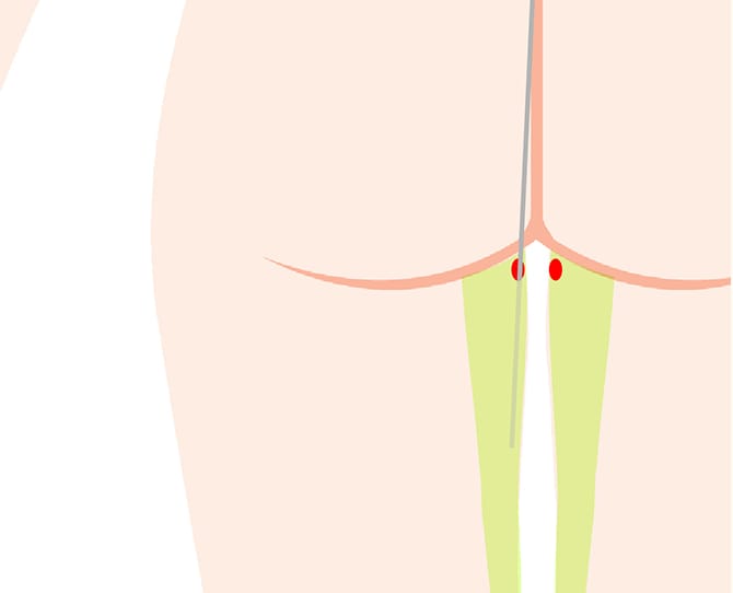 お尻の採脂位置