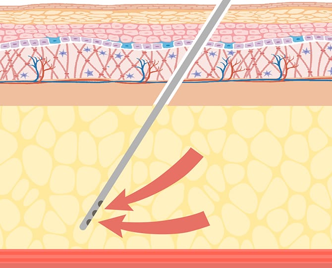カニューレを挿入して脂肪吸引する図