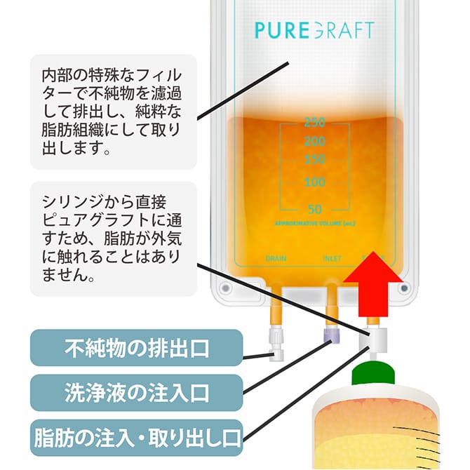 採脂した脂肪をピュアグラフトに通し、加工する図