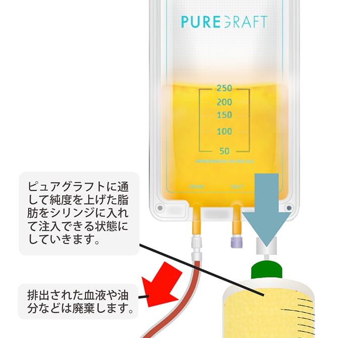 採脂した脂肪をピュアグラフトに通し、加工する図