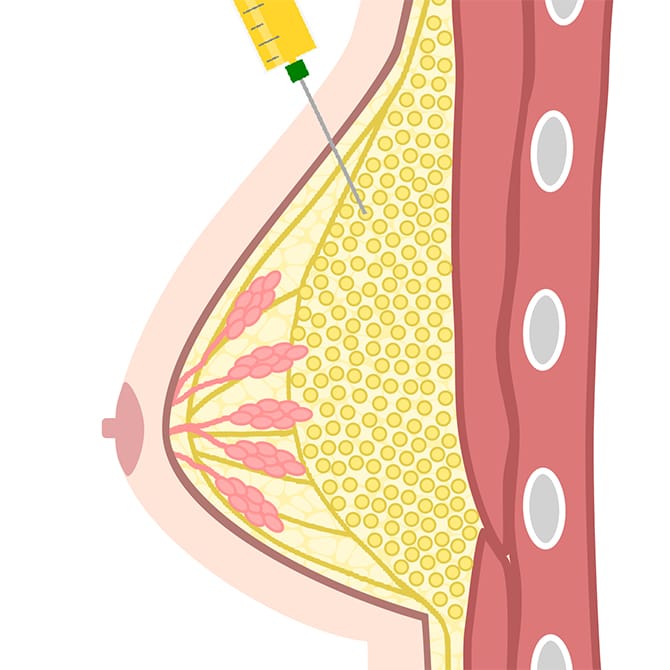 マルチプルインジェクション