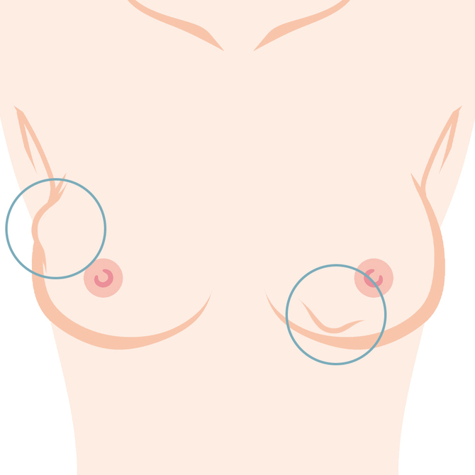 しこり・石灰化