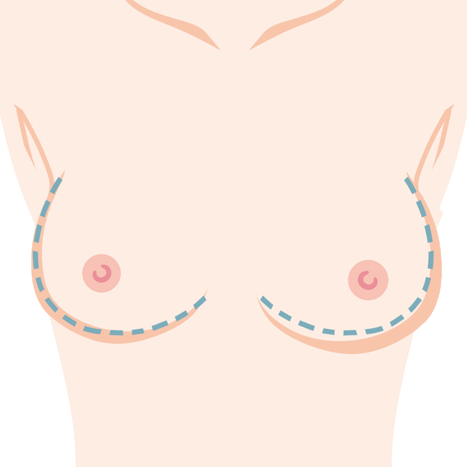 左右差・ボトムアウト