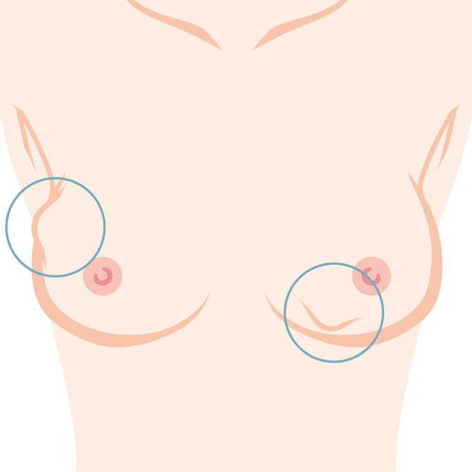 しこり・石灰化