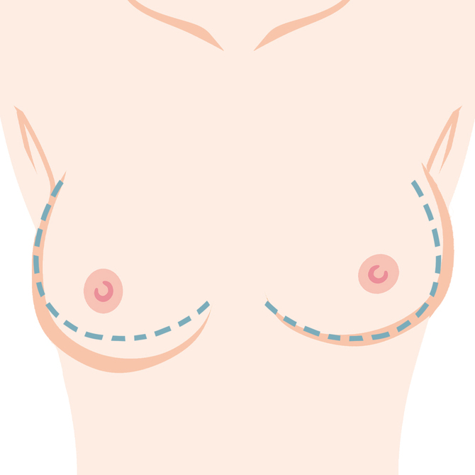 左右差・ボトムアウト