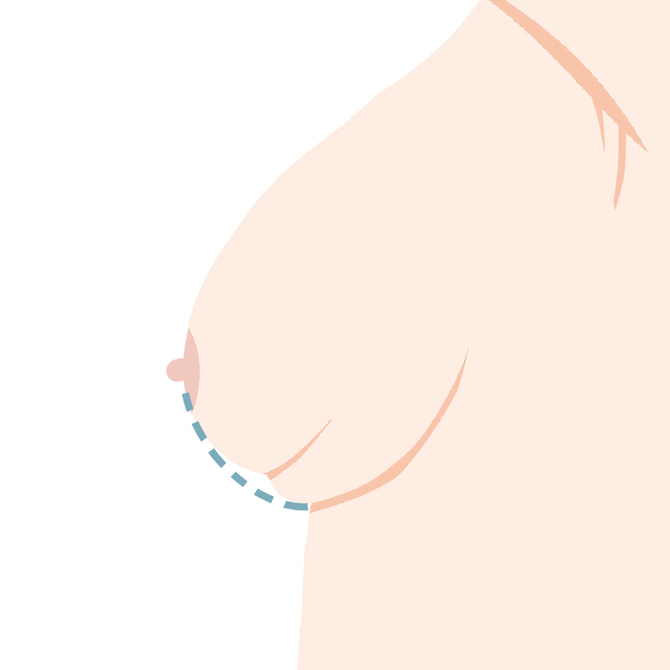 ダブルバブル・段差