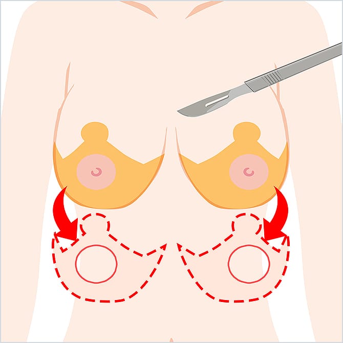 胸の皮膚を錨型に切除するイラスト