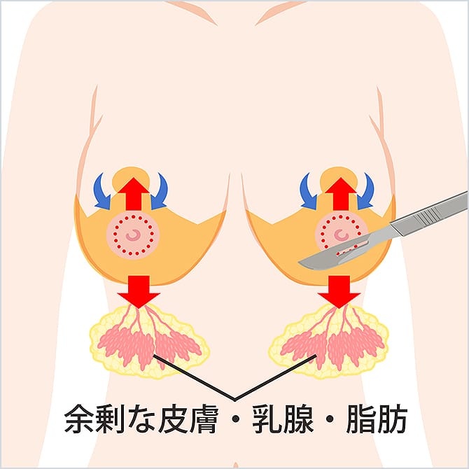 胸の余剰な脂肪や乳腺を切除するイラスト