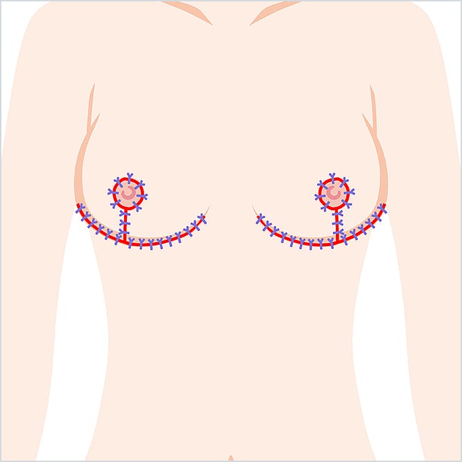 乳輪を縫合するイラスト