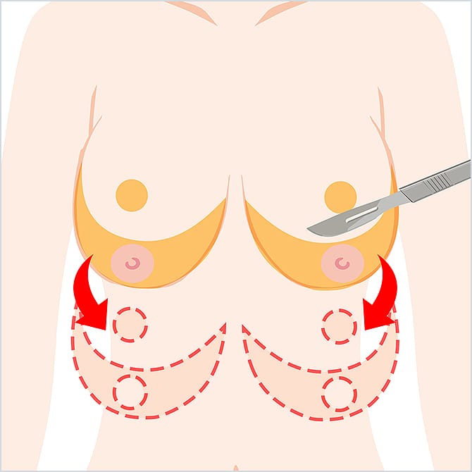 胸の皮膚を切除するイラスト