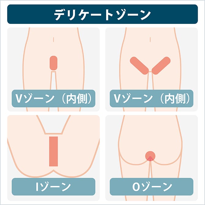 デリケートゾーンの施術部位の図