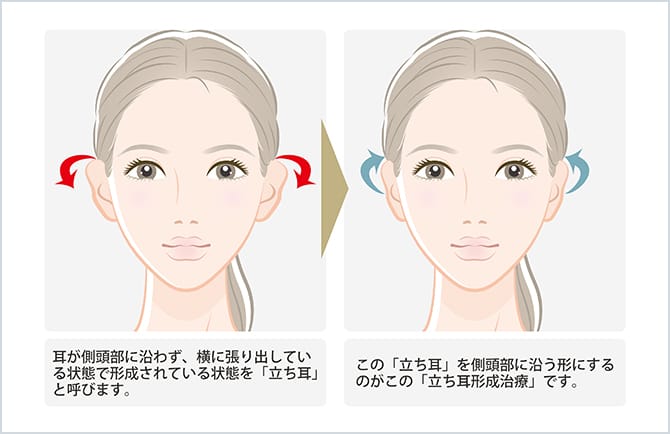 立ち耳と立ち耳形成治療後