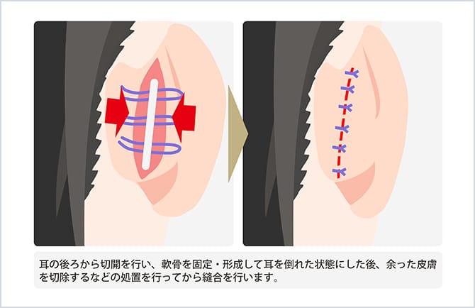 耳の後ろを切開する図
