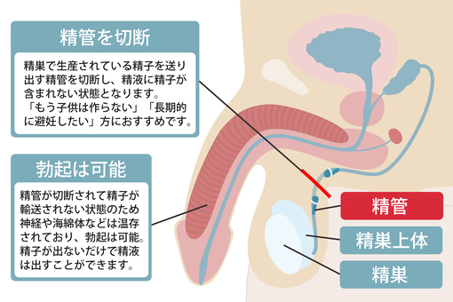 パイプカット