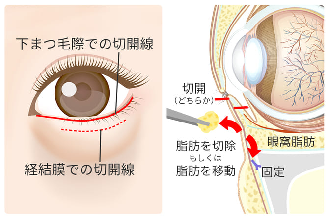 症状に応じて切開治療も