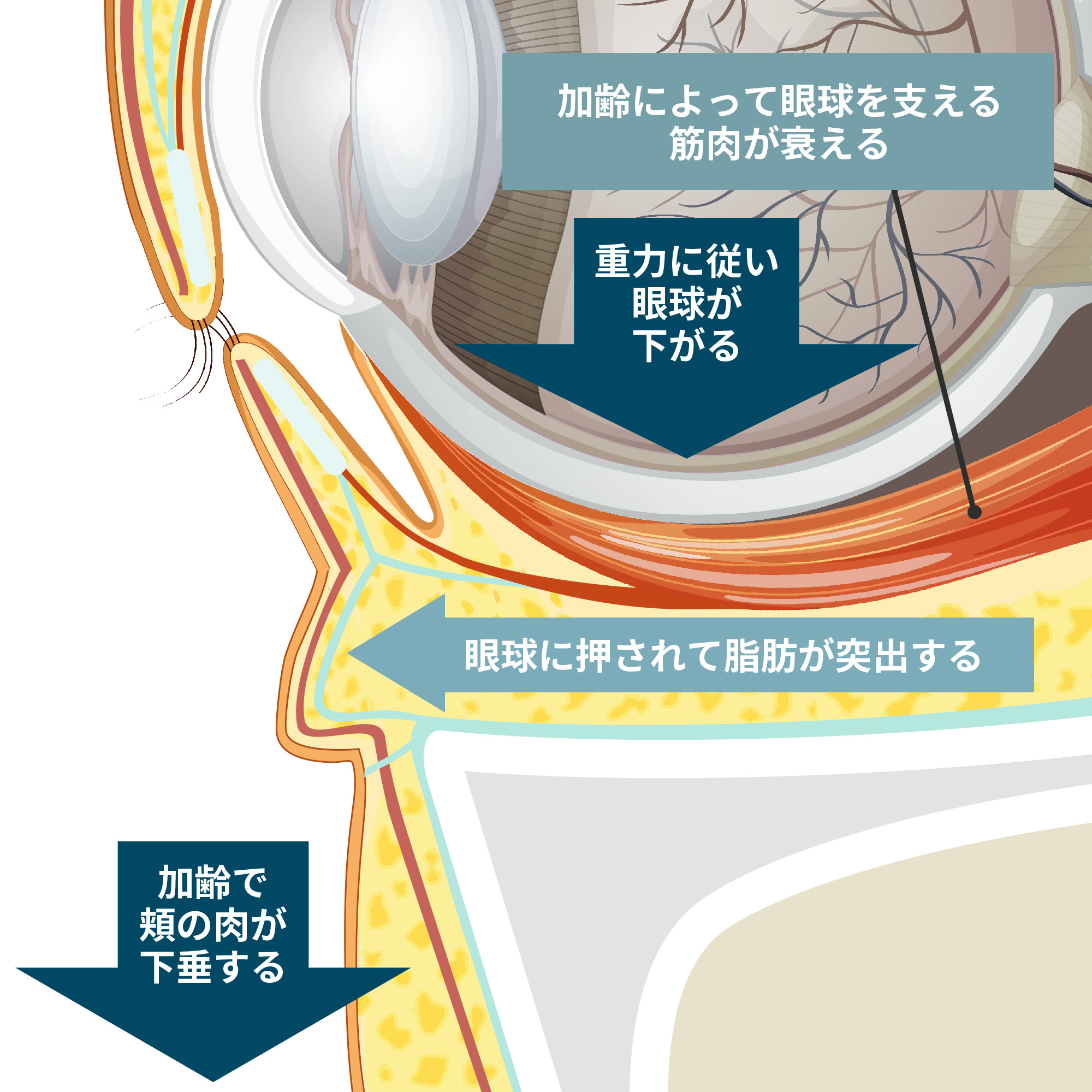 下まぶたの脂肪による凹凸ができる説明図