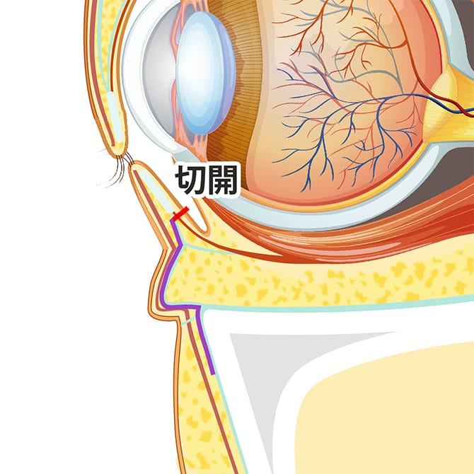 下まぶたの内側の切開