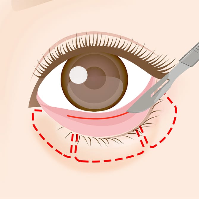 下まぶたの内側の切開