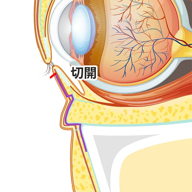 下まぶたの切開