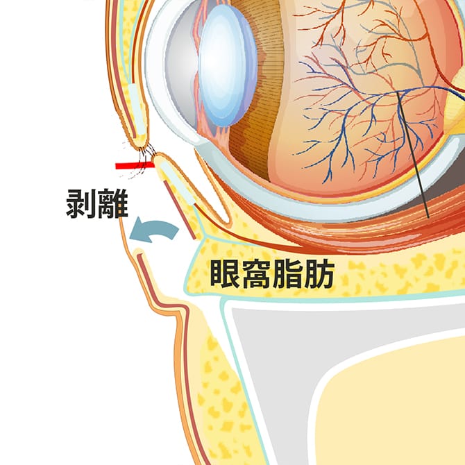 眼輪筋の下の剥離