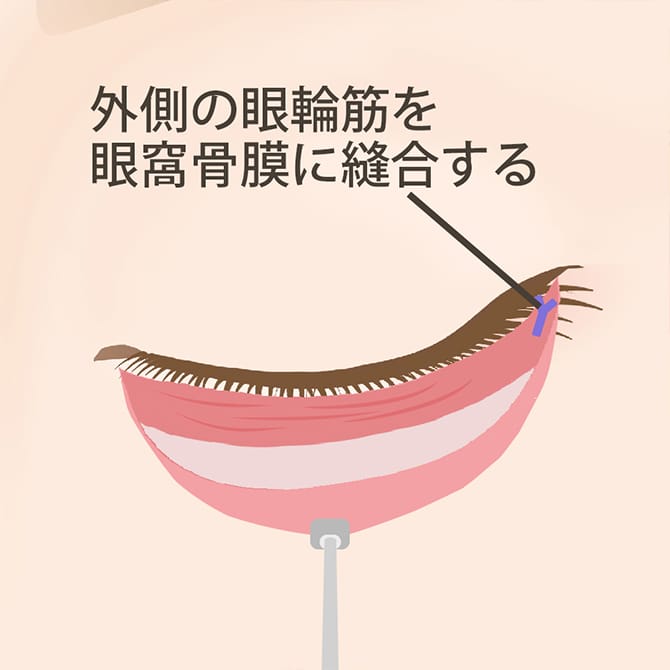 外側の眼輪筋を眼窩骨膜に縫合する図