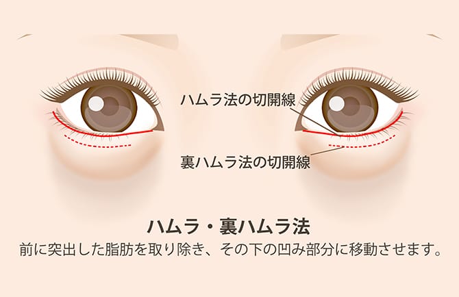 ハムラ法・裏ハムラ法の図